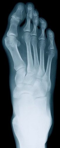 Richland Podiatrist | Richland Rheumatoid Arthritis | WA | Columbia Foot Health Clinic |